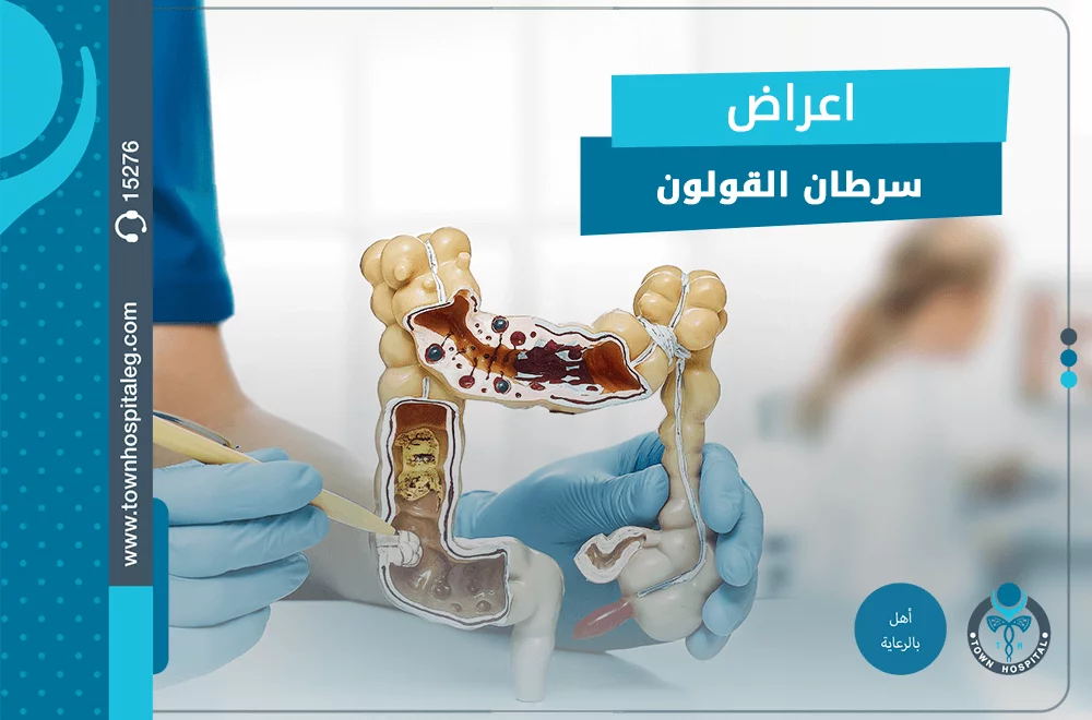 اعراض سرطان القولون